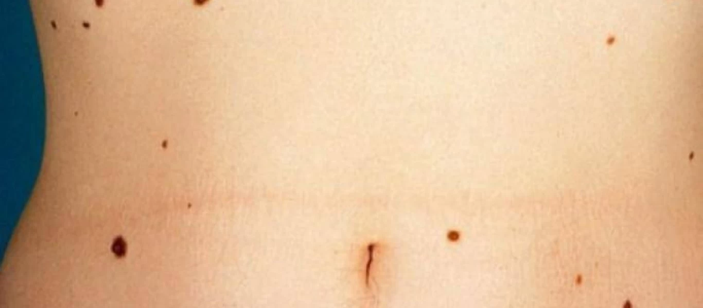 Κόκκινες ελιές στο δέρμα: Πότε εμφανίζονται και τι πρέπει να ξέρετε